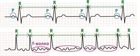 аритмія кардіограма