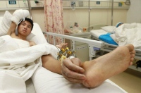 Китайцу пришили отрезанную на работе руку к ноге, чтобы она не умерла